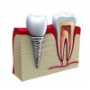 实惠的牙齿种植_专业的牙齿种植机构